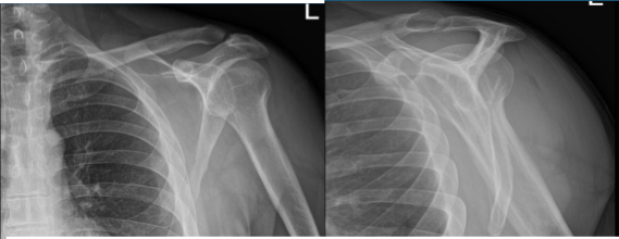 Left Shoulder X-ray