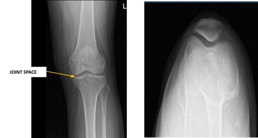 Left knee X-ray complete with patella