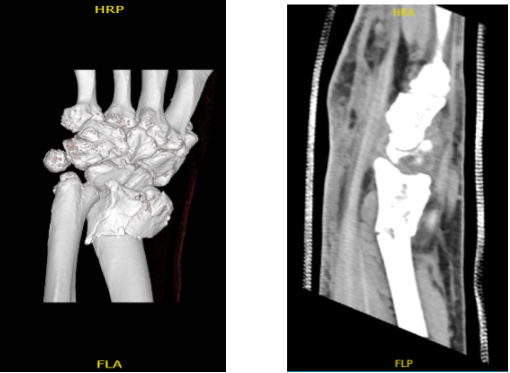 Left wrist pain