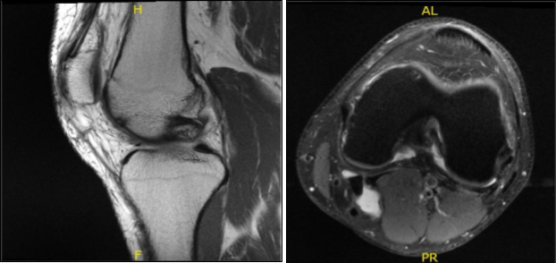 MRI-3T Left Knee Non-contrast