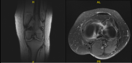 MRI-3T Left Knee Non-contrast