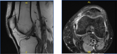 MRI-3T Left Knee Non-contrast