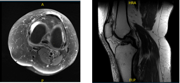 MRI-3T Left Knee non-contrast