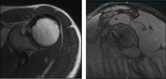 MRI-3T Left Shoulder Non-contrast