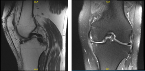 MRI-3T Left knee non-contrast