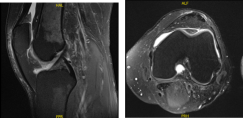 MRI-3T Left knee non-contrast