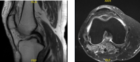 MRI - 3T Right Knee Non-Contrast