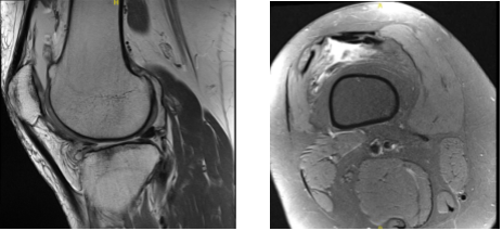 MRI-3T Right Knee Non-Contrast