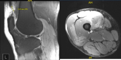 MRI-3T Right Knee Non-contrast