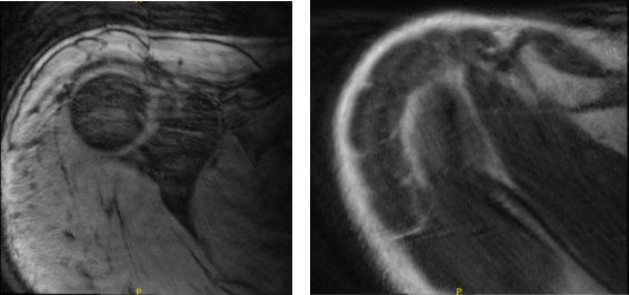 MRI - 3T Right Shoulder Non-contrast