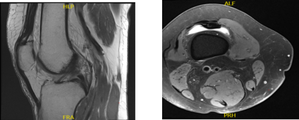 MRI Right Knee Non-contrast