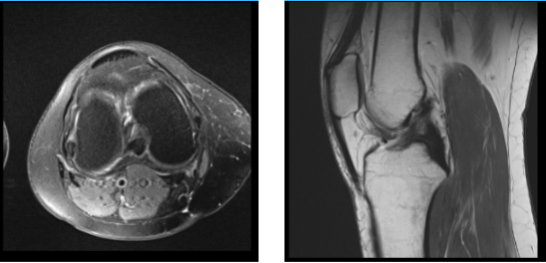 MRI Right Knee Non-contrast