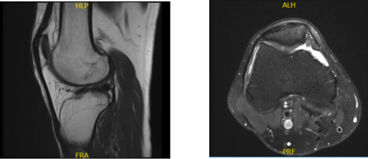 MRI Right Knee non-contrast