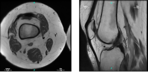 MRI Right knee non-contrast