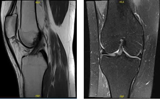 MRI Right knee non-contrast