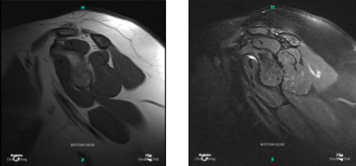 MRI Right shoulder non-contrast