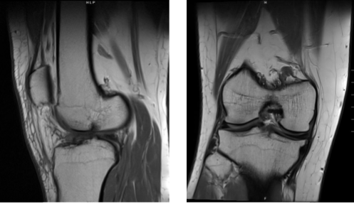 Magnetic resonance imaging scan of the right knee