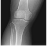 Right Knee X-ray AP Lateral and Oblique 3 views