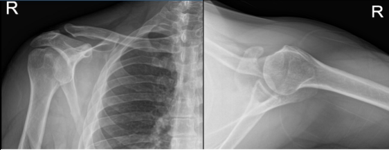 Right Shoulder X-ray