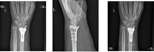 X-ray Left Wrist Minimum 3 views