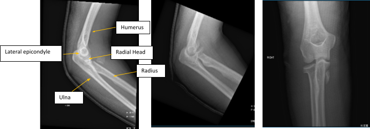 Figure 1. AP Oblique and Flexion Lateral Projection of Right Elbow