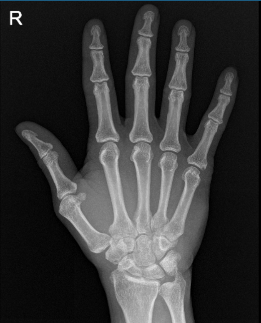 Right hand X-ray complete 3 or more views