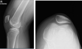 Right knee X-ray complete with Patella