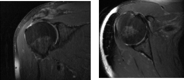 MRI Right Shoulder Non-contrast