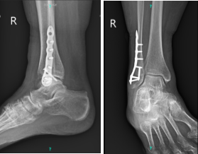 X-ray Right ankle minimum 3 views