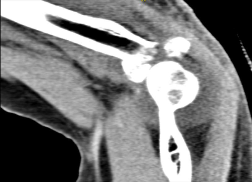 CT Left Elbow Non-contrast