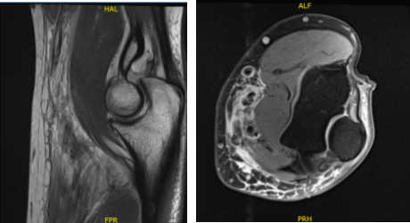 MRI 3T Left Elbow non-contrast