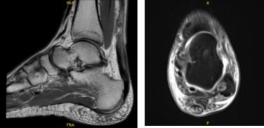 MRI Left ankle non-contrast