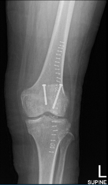 Left knee X-ray AP and Lateral