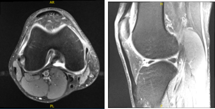 MRI-3T Right Knee non-contrast