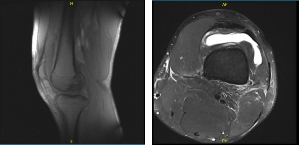 MRI of the left knee