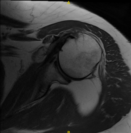 MRI Left Shoulder non-contrast