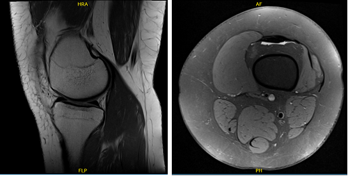 X-ray of left knee