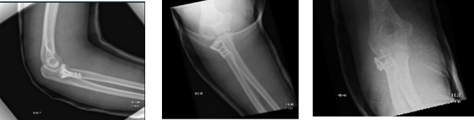 Figure 2. Image of Elbow with 3 cortical screws