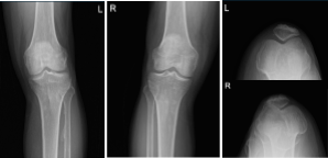 Left and Right knee X-ray complete with patella