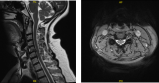 MRI Cervical Spine non-contrast