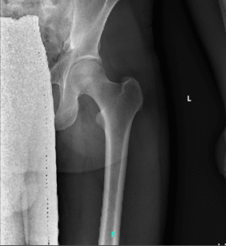 X-ray left hip 2-3 views 