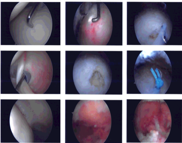 Imágenes artroscópicas tomadas durante la cirugía