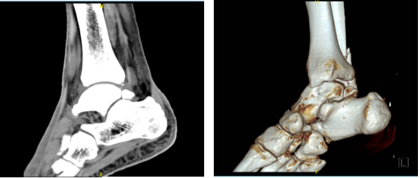 CT Right ankle non-contrast