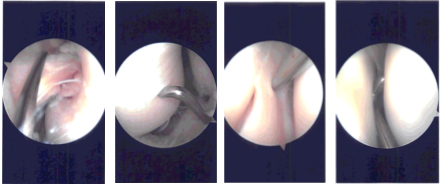 Intraoperative Arthroscopy Images