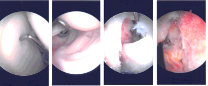 Intraoperative Arthroscopy Images