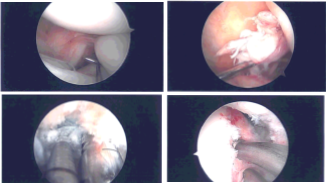 Intraoperative Arthroscopy Images