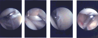 Intraoperative Arthroscopy Images