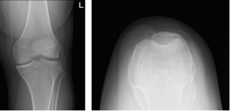 Left knee X-ray complete with patella