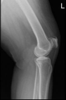 Left knee X-ray