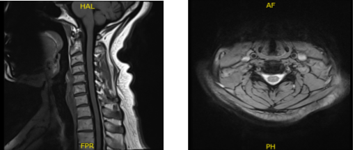 MRI-3T Columna cervical sin contraste